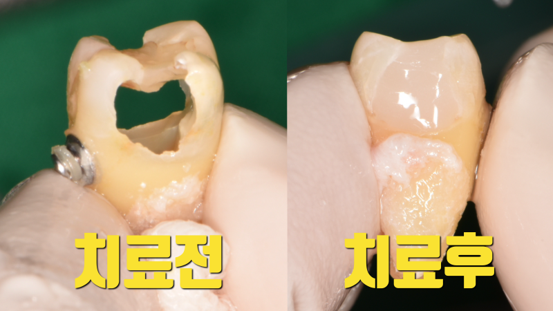 [임상 노트] 충치로 완전히 뚫려버린 치아의 재식술 치아재식술 사진 2