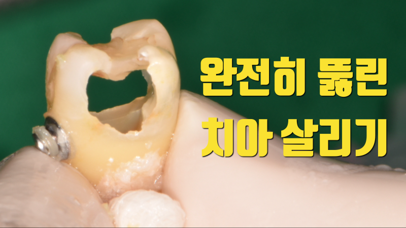 [임상 노트] 충치로 완전히 뚫려버린 치아의 재식술 치아재식술