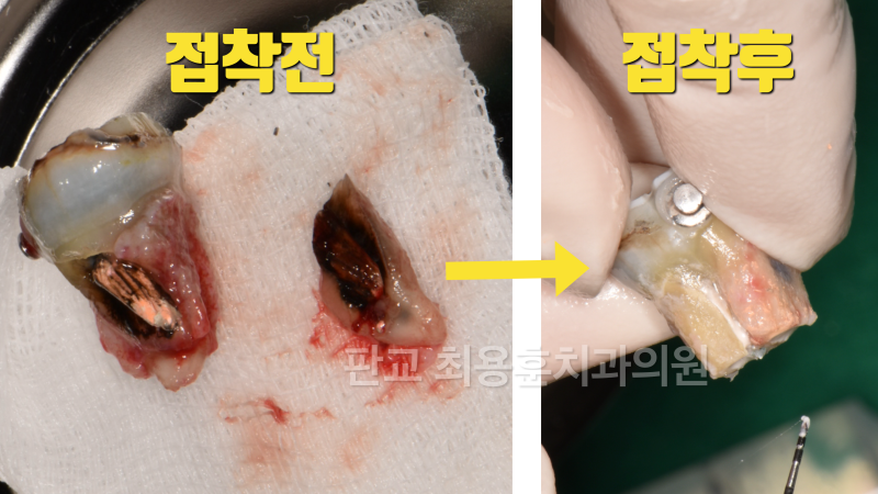 [오늘 살린 치아]치아 뿌리 파절 치아의 접착 재식술 치료 치아재식술 사진 2