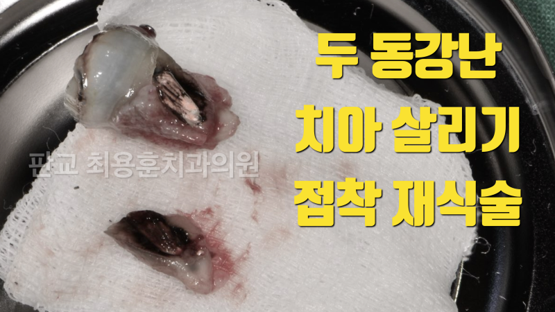 [오늘 살린 치아]치아 뿌리 파절 치아의 접착 재식술 치료 치아재식술