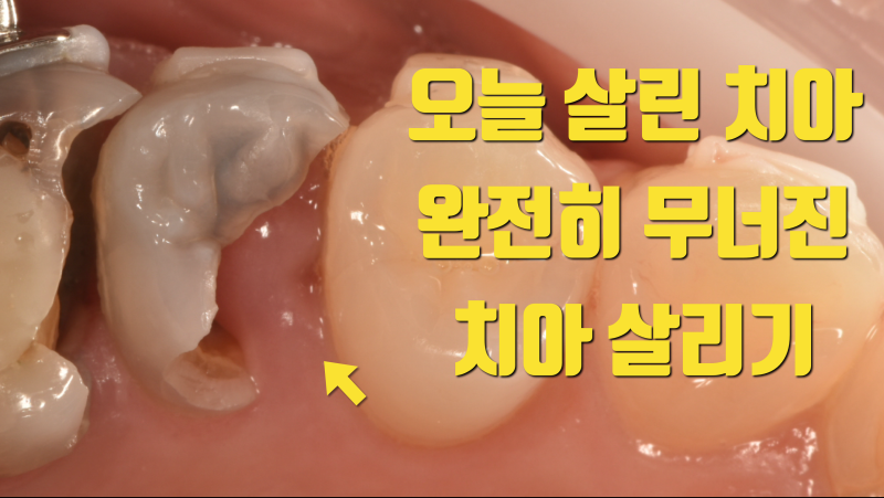 [오늘 살린 치아] 뿌리가 완전히 무너진 치아 재식술로 살리기