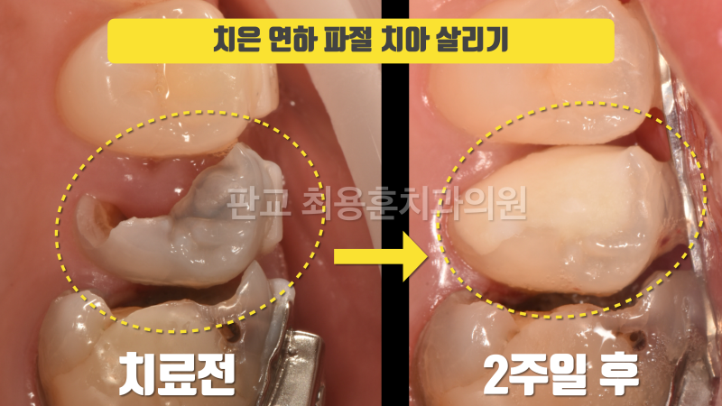 [오늘 살린 치아] 뿌리가 완전히 무너진 치아 재식술로 살리기