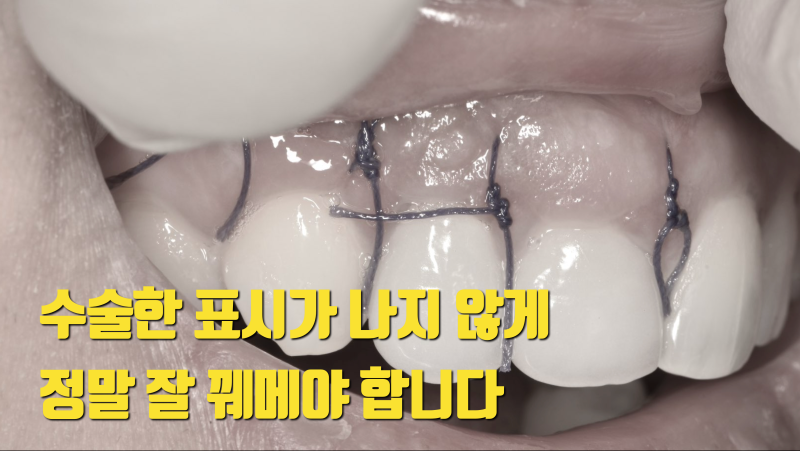 안타까워서 알려주는 치근단 수술의 핵심 요소 사진 3