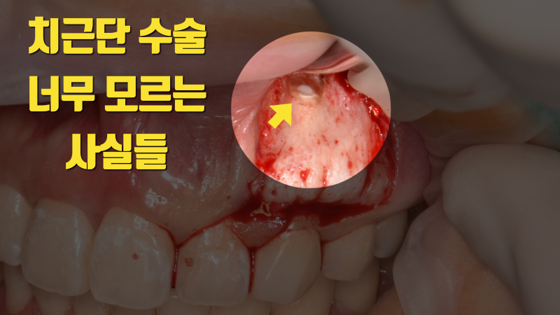 안타까워서 알려주는 치근단 수술의 핵심 요소
