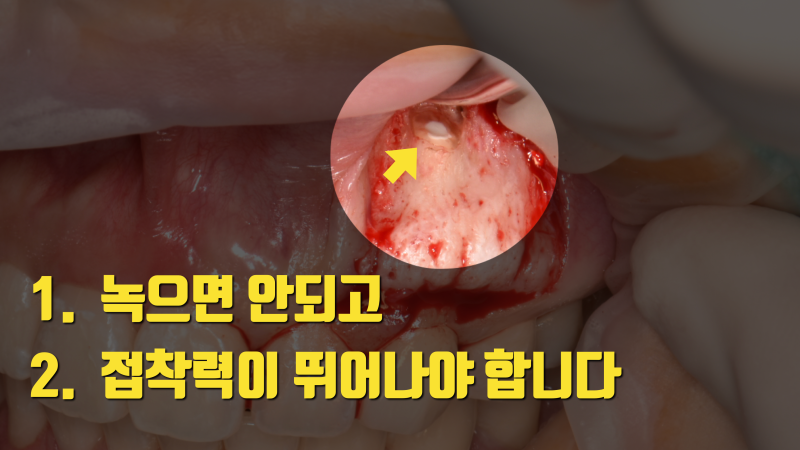 안타까워서 알려주는 치근단 수술의 핵심 요소