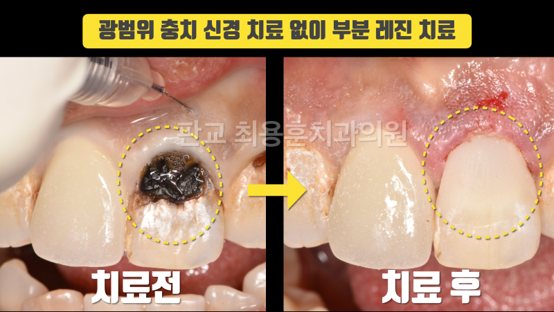 [오늘 살린 치아] 광범위 앞니 충치 치아 살리기 사진 2