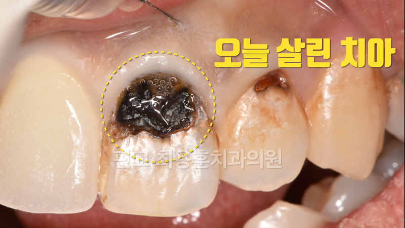 [오늘 살린 치아] 광범위 앞니 충치 치아 살리기