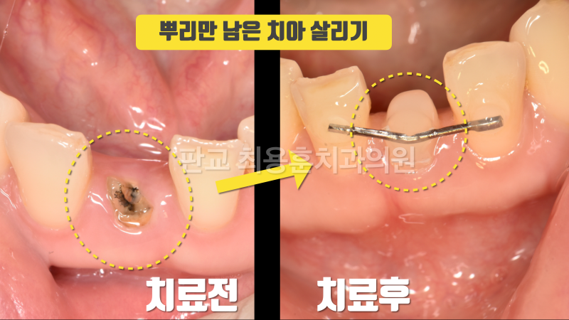 [오늘 살린 치아] 뿌리만 남은 앞니 재식술로 살리기 사진 2