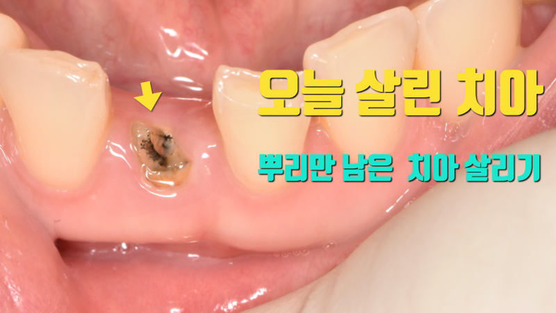 [오늘 살린 치아] 뿌리만 남은 앞니 재식술로 살리기