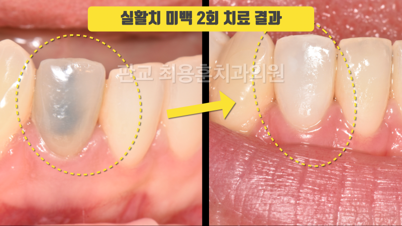 [오늘 살린 치아] 뿌리 중간 파절 손상 있고 변색 심한 치아 재식술로 살리기 사진 3