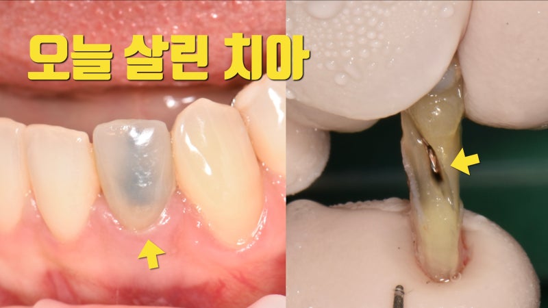 [오늘 살린 치아] 뿌리 중간 파절 손상 있고 변색 심한 치아 재식술로 살리기