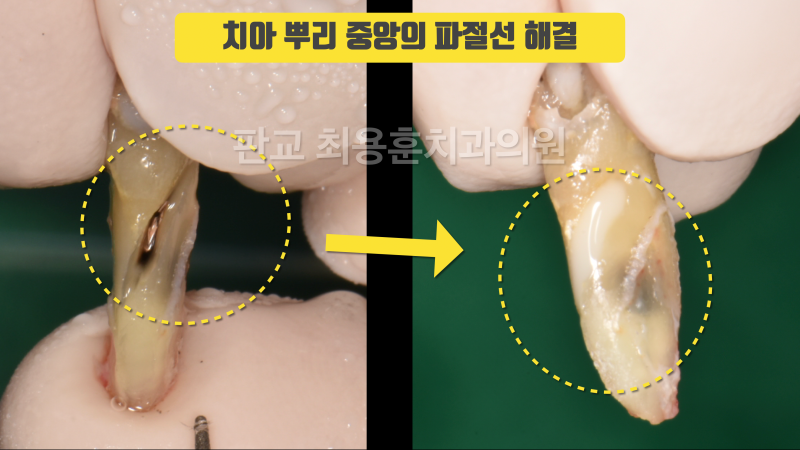 [오늘 살린 치아] 뿌리 중간 파절 손상 있고 변색 심한 치아 재식술로 살리기