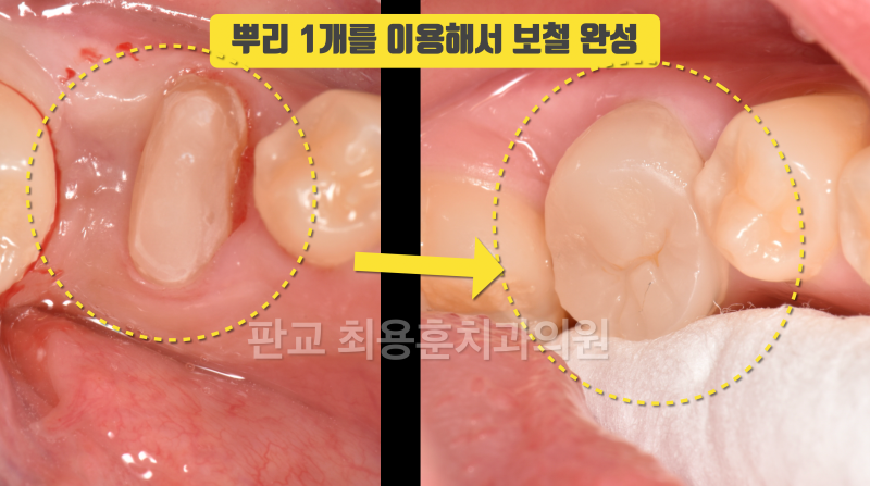 [오늘 살린 치아] 두 동강난 청소년의 재식술로 치아 살리기 #치아재식술 #의도적재식술 #파절치아살리기 사진 3