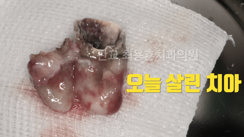 [오늘 살린 치아] 두 동강난 청소년의 재식술로 치아 살리기 #치아재식술 #의도적재식술 #파절치아살리기