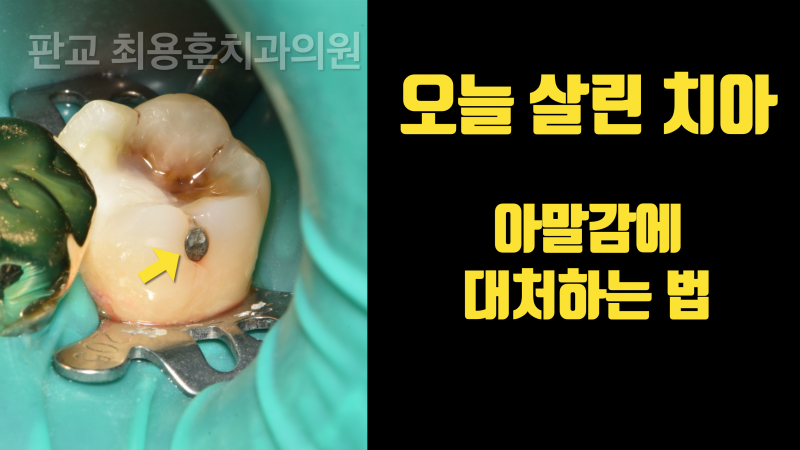 [오늘 살린 치아] 소심하게 치아를 치료해야 하는 이유