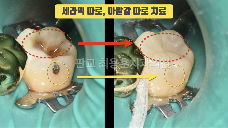 [오늘 살린 치아] 소심하게 치아를 치료해야 하는 이유