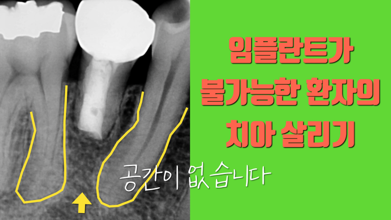 [오늘 살린 치아] 자연 치아가 아니면 답이 없는 환자 재식술로 살리기