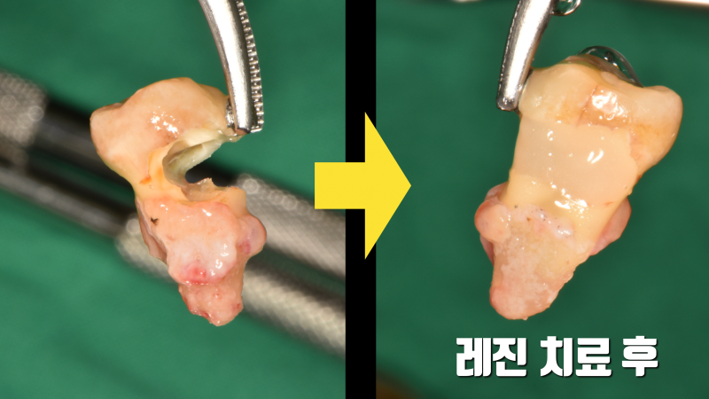 [오늘 살린 치아] 부러지기 직전의 치아재식술 치아 살리기 사진 3