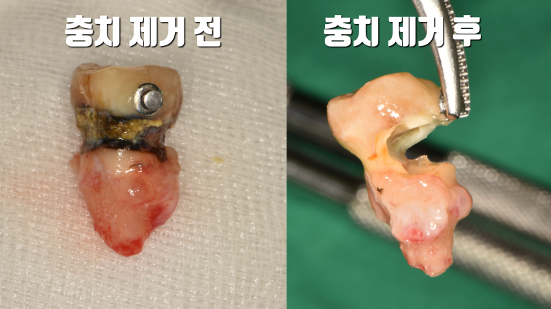 [오늘 살린 치아] 부러지기 직전의 치아재식술 치아 살리기