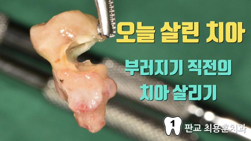 [오늘 살린 치아] 부러지기 직전의 치아재식술 치아 살리기