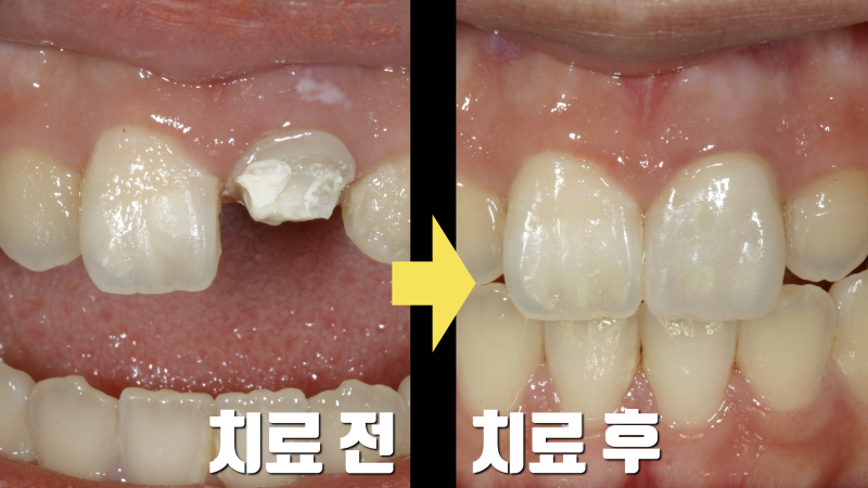 [심미 보철 치료 명의 소개] 마이스터 치과 고여준 원장님