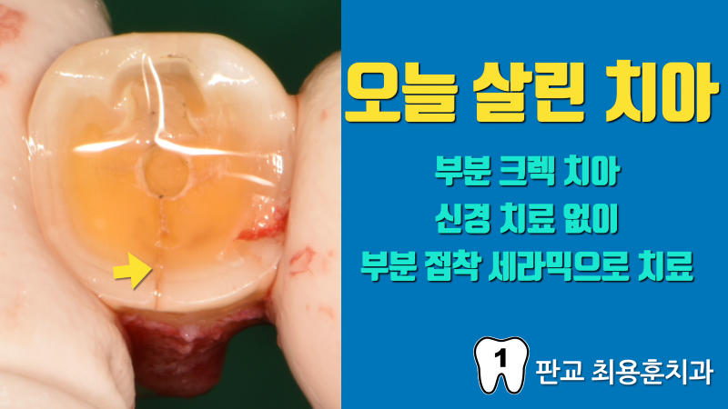 [오늘 살린 치아] 부분 크렉 치아의 부분 접착 세라믹으로 잘 쓰고 있는 경우