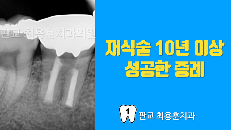 [오늘 살린 치아] 치아재식술 10년 이상 경과 증례