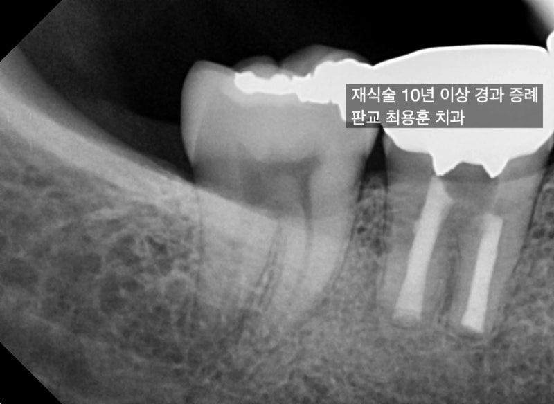 [오늘 살린 치아] 치아재식술 10년 이상 경과 증례