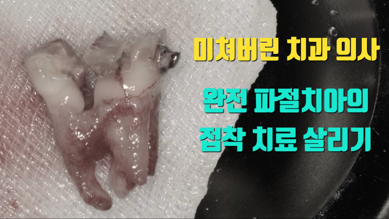 [오늘 살린 치아] 완전 파절 치아의 재식술 접착 살리기