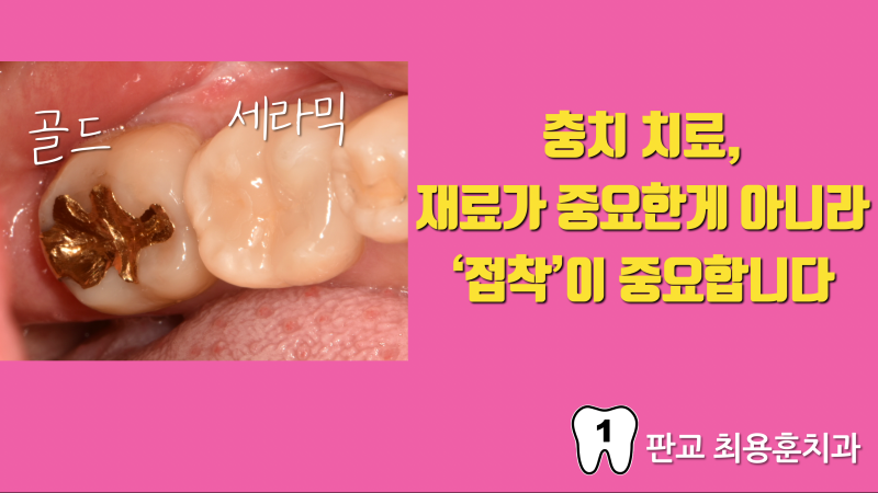 충치 치료는 '접착'을 해야 합니다