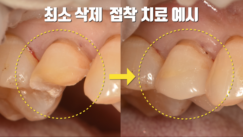 충치 치료는 '접착'을 해야 합니다