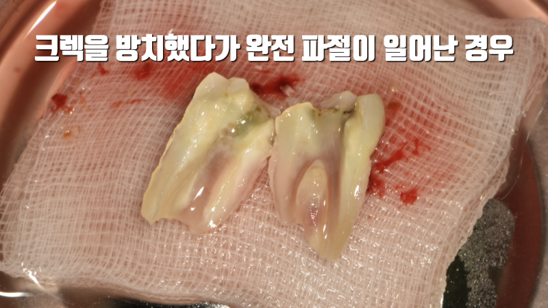 초기 어금니 크렉은 미리 치료하는 걸 추천합니다