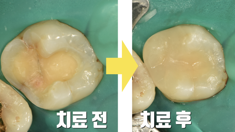초기 어금니 크렉은 미리 치료하는 걸 추천합니다 사진 4