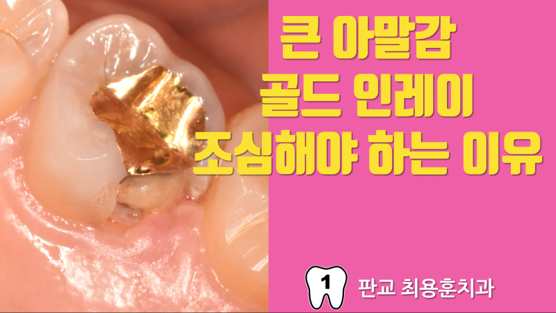 큰 아말감, 인레이 주의해야 하는 이유