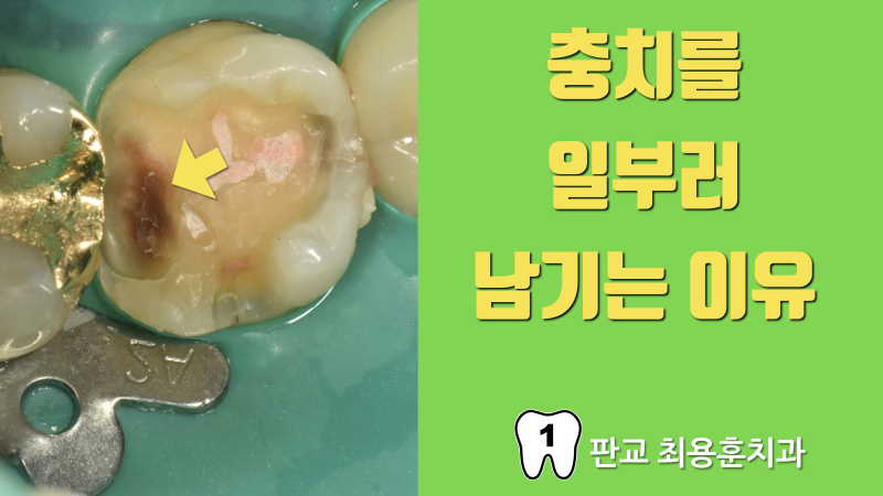 충치를 다 제거하면 안됩니다