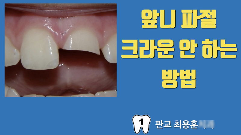 앞니 부서진 치아의 해결 방법