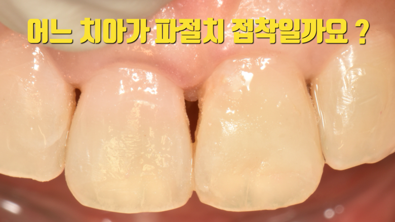 앞니 부서진 치아의 해결 방법