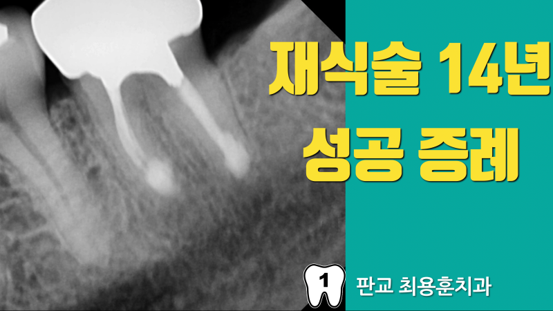 재식술 치아 살리기의 믿을 수 있는 결과