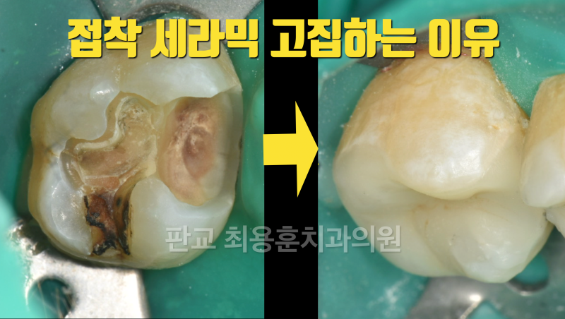어렵고 힘들지만 세라믹 고집하는 이유