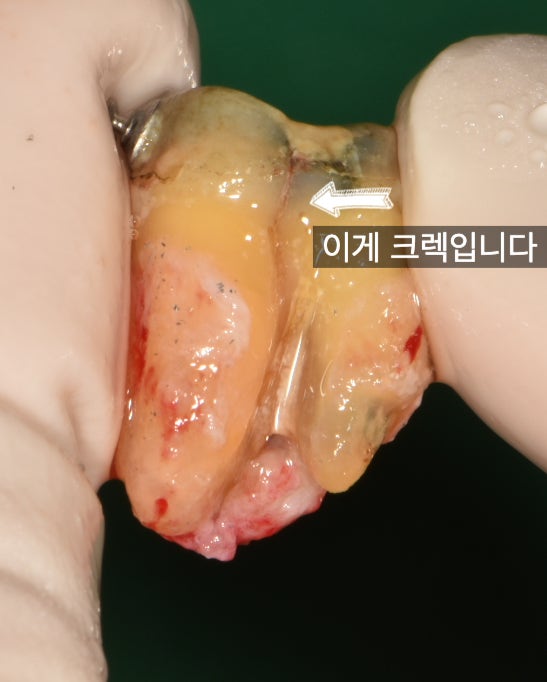 재식술 할 때는 크렉이 있다고 생각하고 준비해야 합니다 사진 2