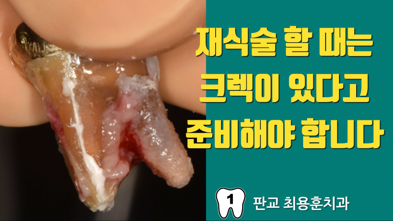 재식술 할 때는 크렉이 있다고 생각하고 준비해야 합니다