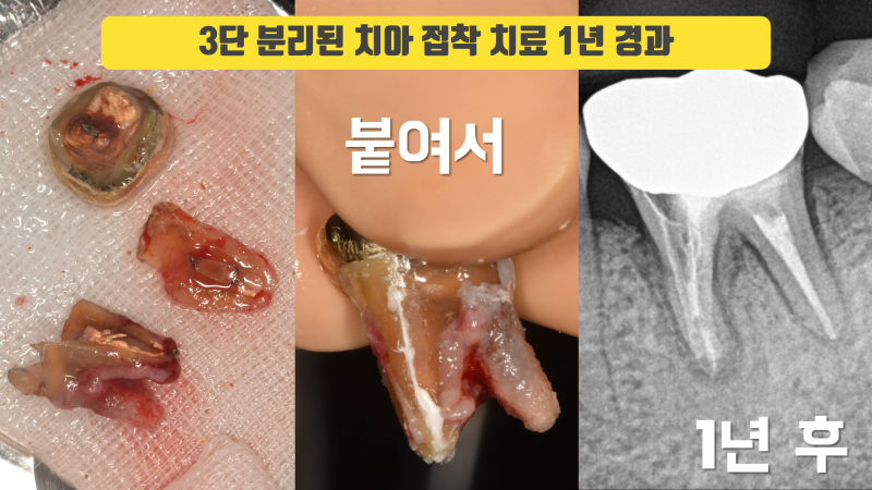 재식술 할 때는 크렉이 있다고 생각하고 준비해야 합니다