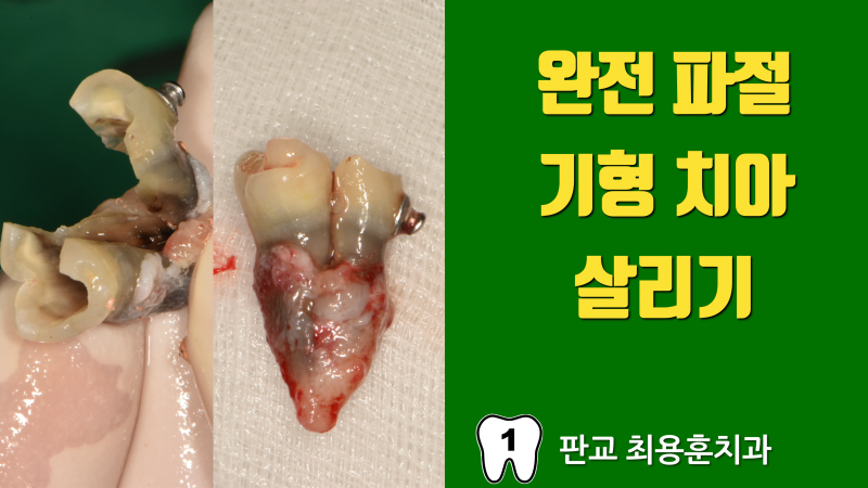 [오늘 살린 치아] 완전 파절된 기형 치아를 살린 증례