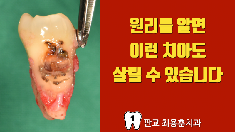 치아 살리기의 원리와 근거