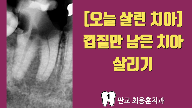 [오늘 살린 치아] 껍질만 남은 치아를 살려야 한다