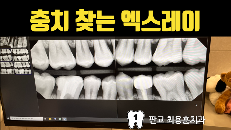 충치 검진은 바이트 윙(Bite-wing) 엑스레이를 찍어야 합니다