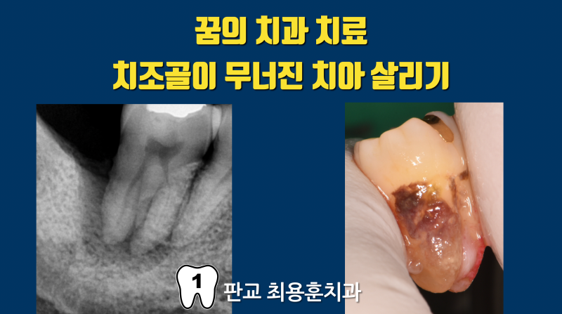 치과 치료의 미래 : 무조건 발치해야 하는 치아를 살린다