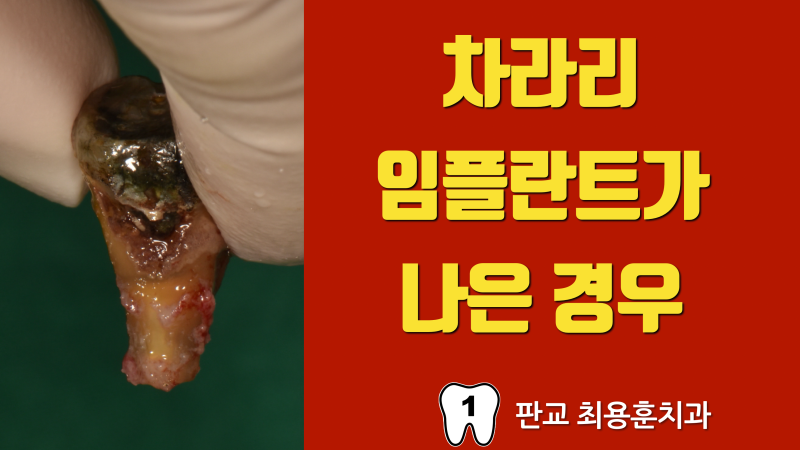임플란트가 나쁜 선택이 아닙니다