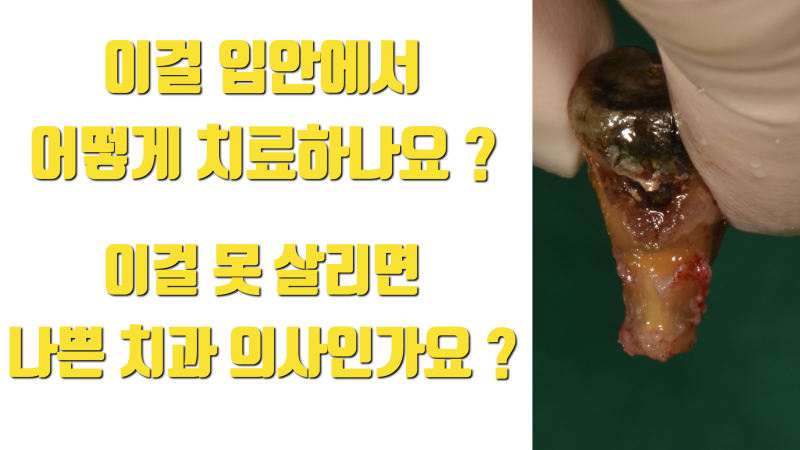임플란트가 나쁜 선택이 아닙니다