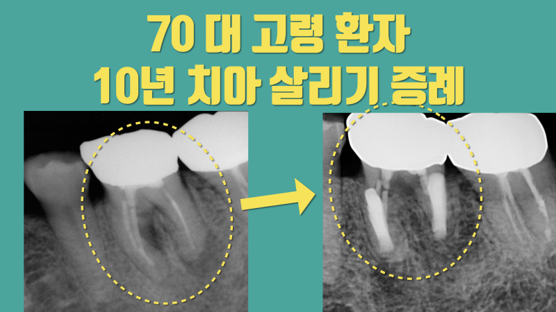 70대 고령 환자 치아 재식술 10년 성공 증례